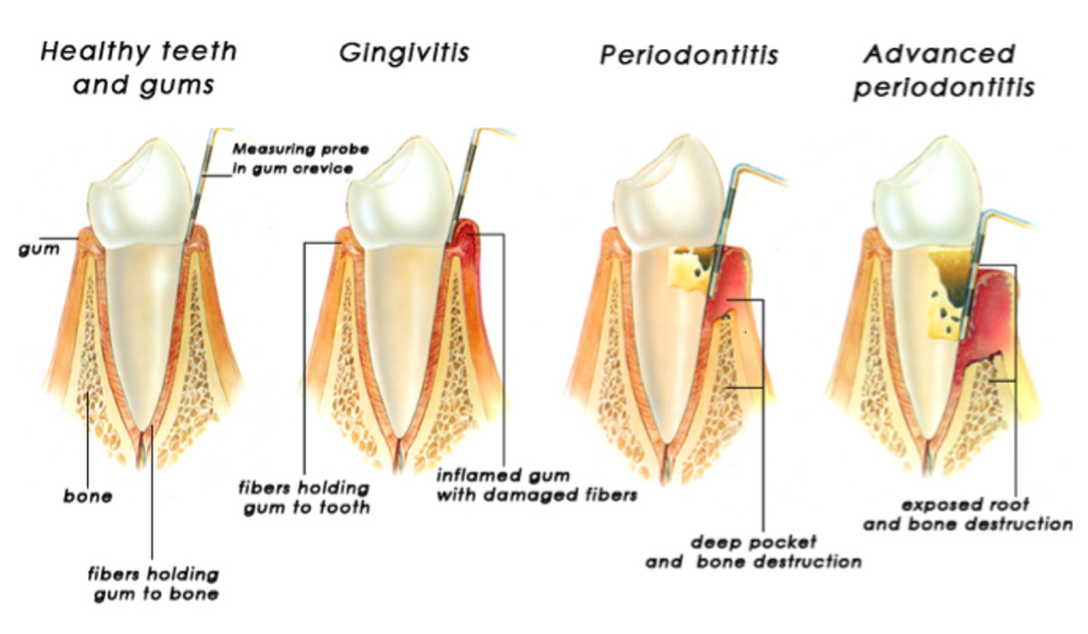 How do we measure gum disease